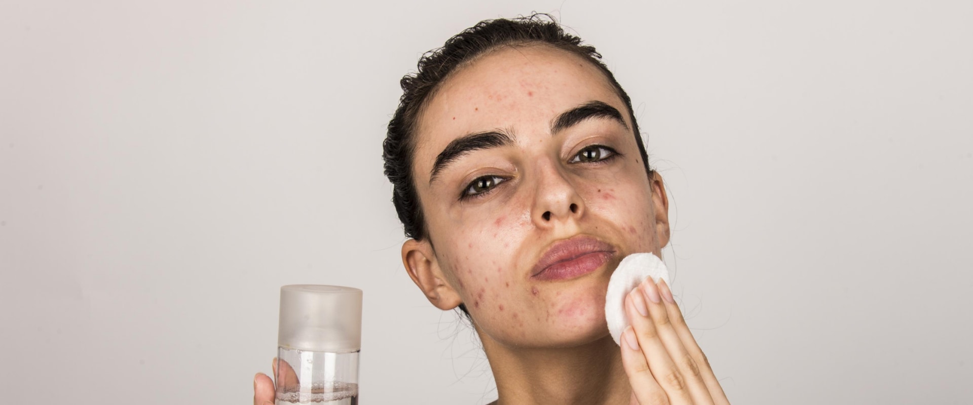 Cleansing for Acne-Prone Skin: How to Clear Your Skin and Prevent Future Breakouts