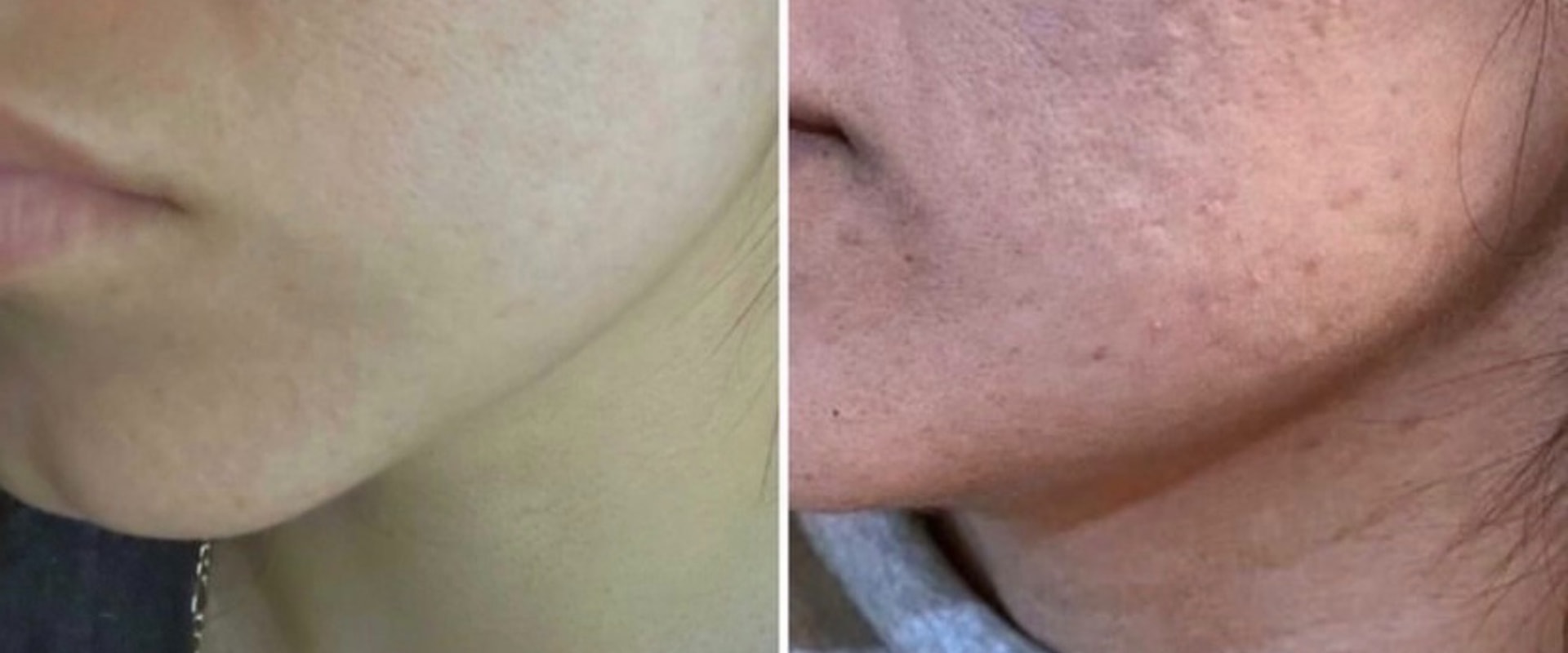 Understanding Microneedling for Acne Scars