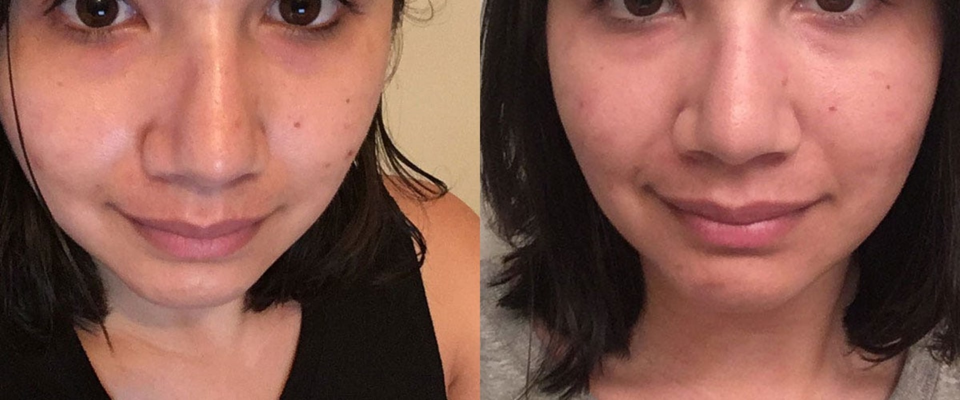 An In-Depth Look at Apple Cider Vinegar Toner for Acne Treatment