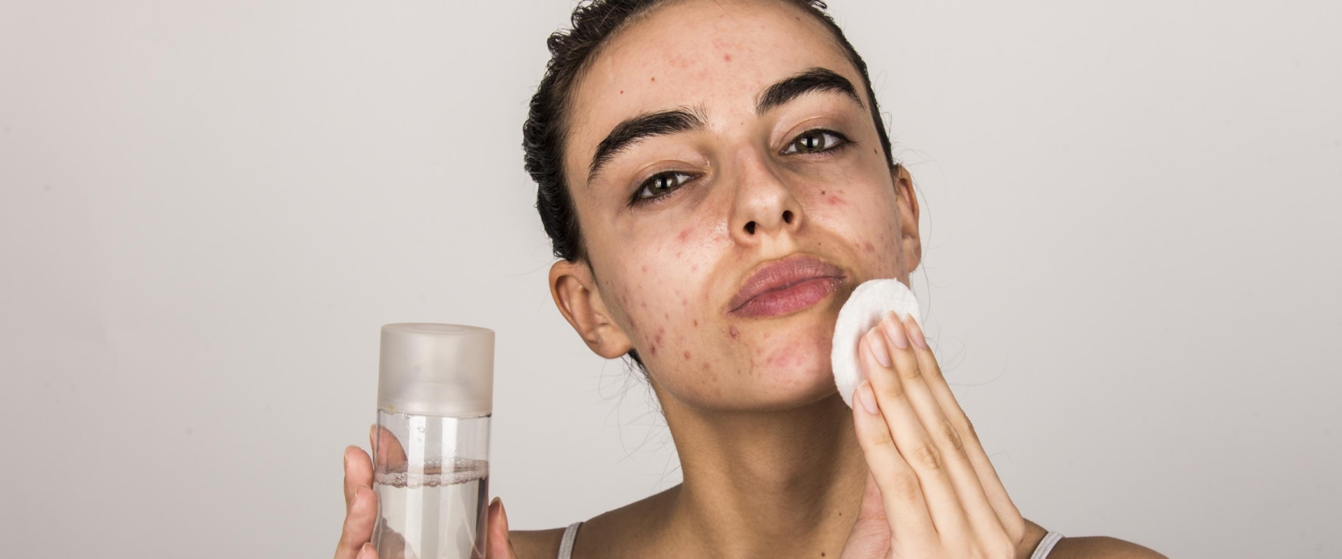 Sun Protection for Acne-Prone Skin: How to Keep Your Skin Clear and Healthy