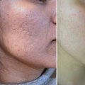 Understanding Microneedling for Acne Scars