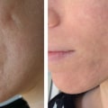 The Importance of Early Treatment for Acne Scarring