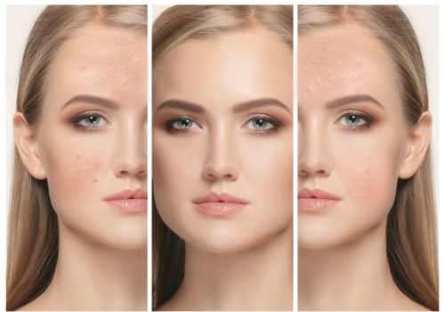 Laser Treatments for Acne Scars: Your Ultimate Guide to Clearer Skin