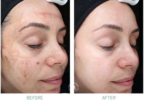 Gentle Exfoliation for Acne Scars