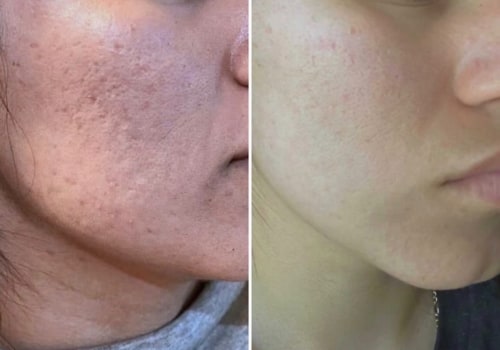 Understanding Microneedling for Acne Scars