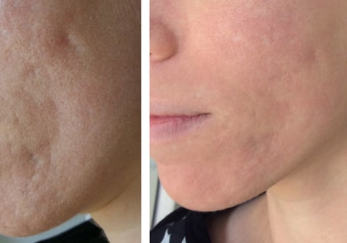 The Importance of Early Treatment for Acne Scarring